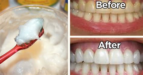 How To Use Baking Soda Correctly To Whiten Your Teeth In Just 5 Days