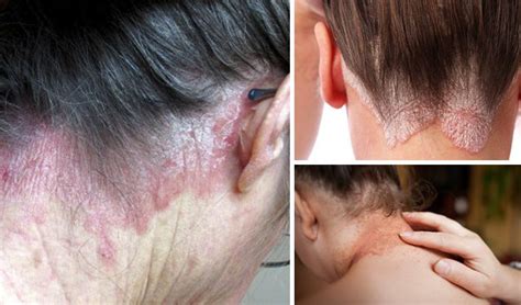 Psoriasis On The Neck Causes Symptoms And Treatment Psoriasis Expert