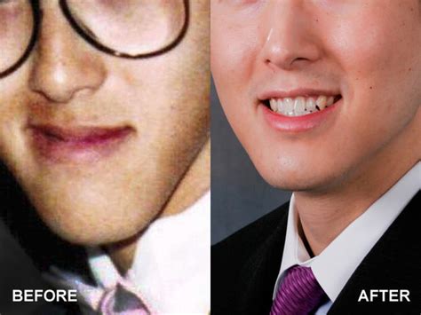 Upper Lip Lift 13 Bizarre But Popular Plastic Surgery Procedures
