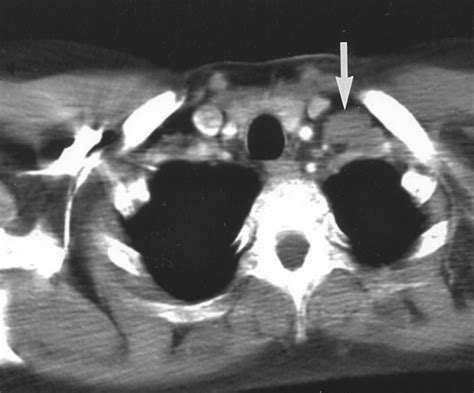 Sonographically Guided Biopsy Of Supraclavicular Lymph Nodes A Simple