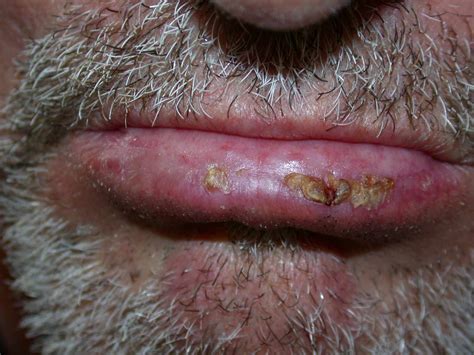 Actinic Cheilitis Pictures Lip Changes And Treatment