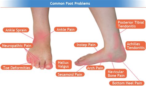 Foot Pain Identifier Chart Sexiz Pix