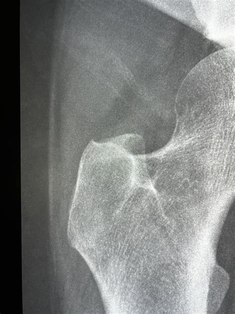 Sameer Raniga On Twitter 53f Severe Left Lateral Hip Pain With