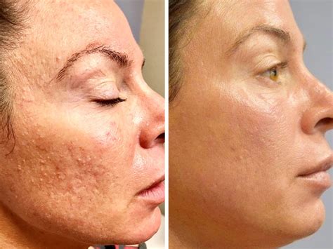 Microneedling Photos Roseville Before And After Chemical Peels