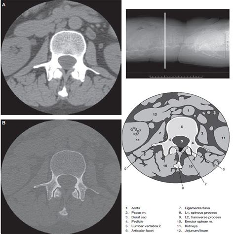 Lumbar Spine Ct Scan Radtechonduty