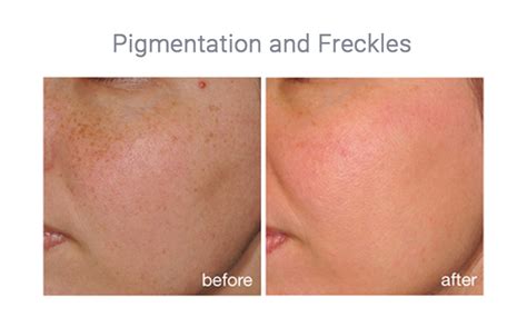 Ipl Photorejuvenation In Brantford Ontario