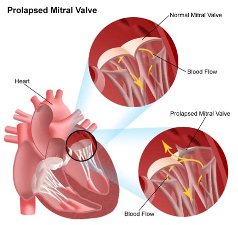 Mitral Valve Prolapse Surgery Mitral Valve Mitral Valve Prolapse Cardiac Nursing