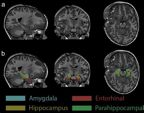 Amygdala And Surrounding Structures On Anatomical Mri A A