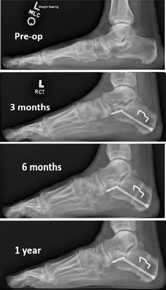 The Cotton Osteotomy In Flexible Flatfoot Correction