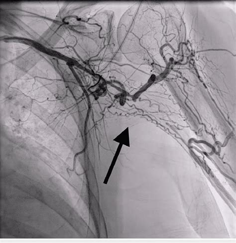 Angiogram Of The Left Upper Extremity Demonstrating Left Download