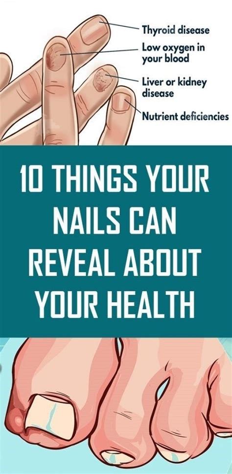 Here Are Things Your Nails Can Reveal About Your Health Viral Health Health Health