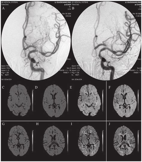 DSA And CT Images Of Patients With Middle Cerebral Artery Stenosis A