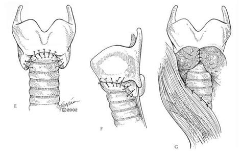 Resection And Reconstruction Anterior Subglottic Stenosis Trachea And