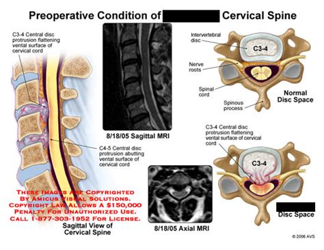 Amicus Illustration Of Amicus Injury Condition Cervical Spine Disc Herniation Extrusion Sagittal