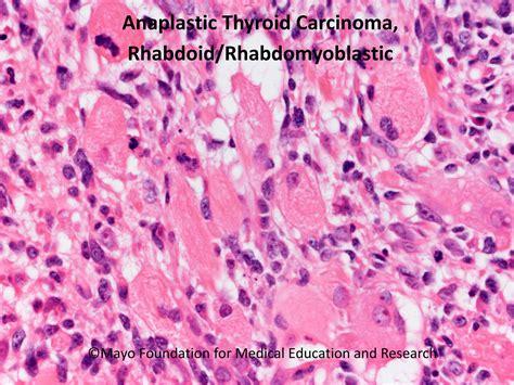 Anaplastic Thyroid Carcinoma Mayo Clinic Proceedings