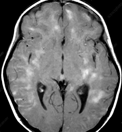 Mri Of Adem Stock Image C0435521 Science Photo Library