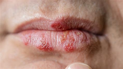 How To Tell The Difference Between Cold Sores And Chapped Lips