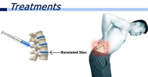 But disc surgery is a necessary option for certain symptoms such as paralysis due to nerve root compression or persistent. Singapore Paincare Center: What is Herniated Disc and How to cure it?
