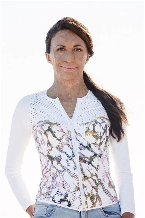 Turia Pitt Speaker Inspirational Keynote And Guest Resilience Speaker Icmi