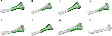 Models Of Intra Articular Fractures Of The Distal Humerus A Novel