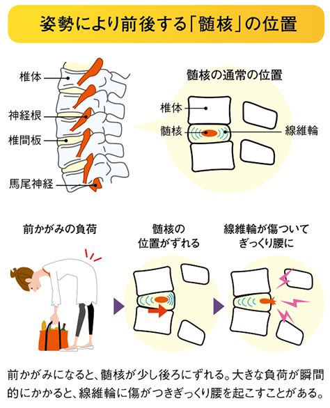 The latest tweets from しぐれうい(@ui_shig). 腰痛は悪い姿勢による腰への負担や心理的ストレスが主な原因 ...