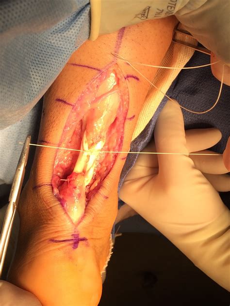 A tough cord or band of dense white fibrous connective tissue that unites a muscle with some other part (such as a bone) and transmits the force which the muscle exerts examples of tendon in a sentence Employing Free Semitendinosus Allograft For Repair Of A ...