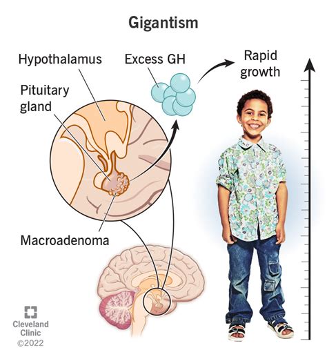 gigantism what it is causes symptoms and treatment