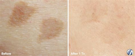 Pigmented Lesion Brown Spot Removal Dallas Texas