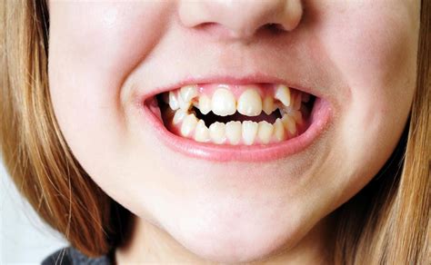 A dental professional will bond them to the front of your teeth, then smooth and polish them so that they look like natural teeth. What Is the Best Option to Fix Crooked Teeth? | Your Gold ...