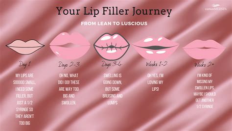 Juvederm™ And Versa™ Lip Fillers At Camas Medspa Get Beautiful Lips