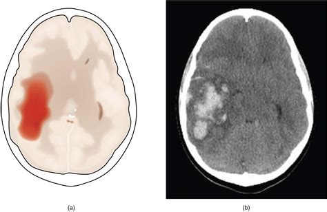 Contusión Cerebral Definición Síntomas Consecuencias Y Más