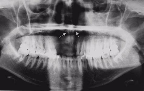 Cureus Bilateral Inverted Mesiodens A Rare Case Evaluated By Cone