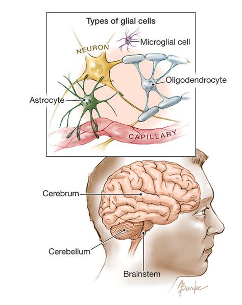 Gliomas Neuro Oncology Jama The Jama Network