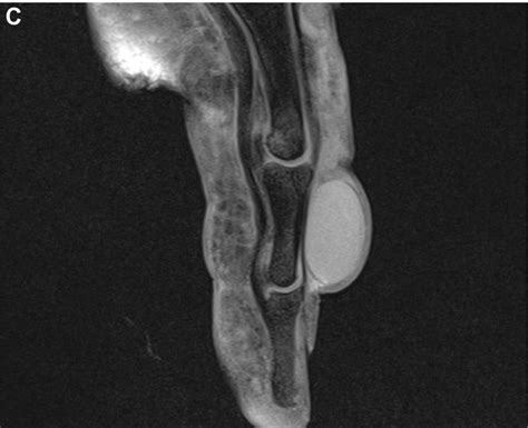Epidermal Inclusion Cyst Notes A Oblique Radiograph Of The Left