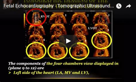 Tomographic Ultrasound Imaging Tui Of The Fetal Heart