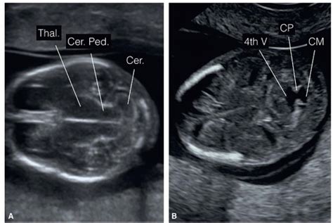 The Fetal Central Nervous System Radiology Key