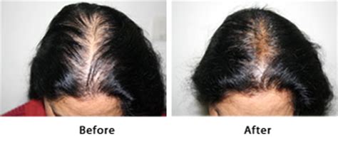 Heat styling = rambut rosak. Mesoterapi Merawat Rambut Gugur | Premier Clinic