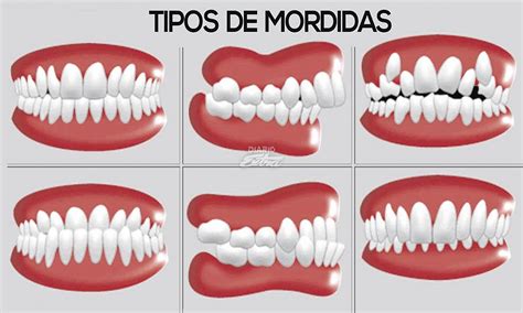 Ortodoncia ¿qué Tipos De Mordidas Existen Directorio Odontológico