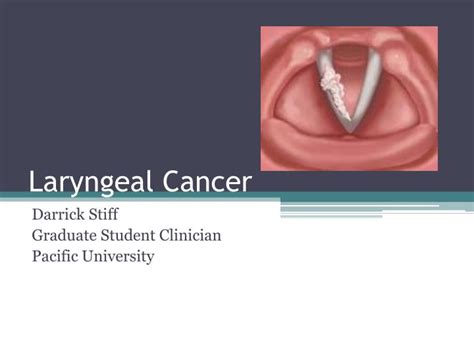 Laryngeal cancer symptoms include voice changes, such as hoarseness, and a sore throat or cough that doesn't go away. PPT - Laryngeal Cancer PowerPoint Presentation, free ...
