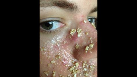 Pimples Popping On Nose Video Blackhead Popping