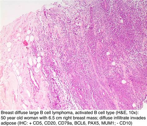 Pathology Outlines Lymphoma