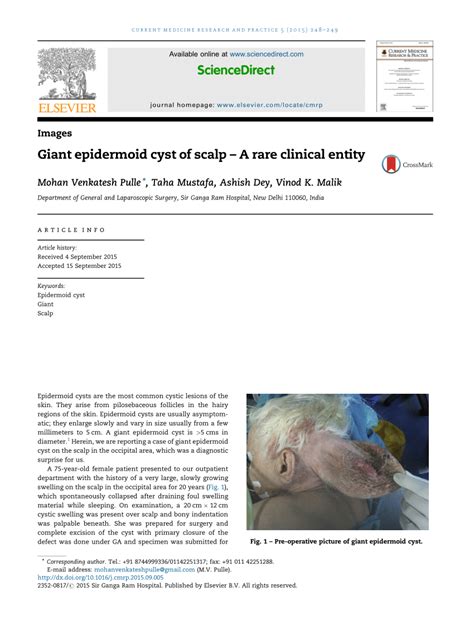 Pdf Giant Epidermoid Cyst Of Scalp A Rare Clinical Entity
