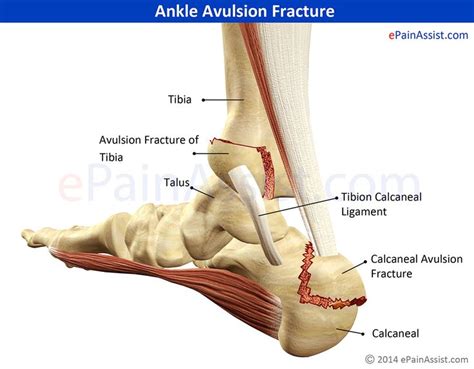 Ankle Avulsion Fracture Symptoms Causes Treatment Avulsion Fracture
