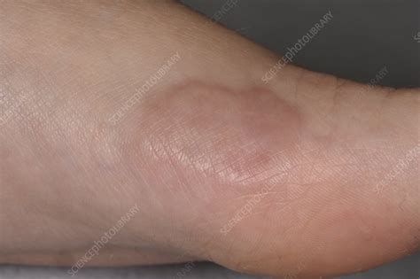 Skin Lesion Stock Image C0498687 Science Photo Library
