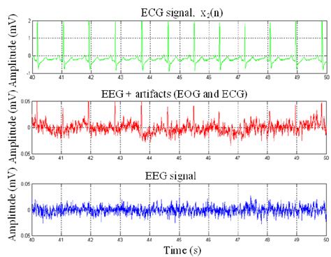 Ecg Artifact Cancellation A Real Ecg B Eeg Record Contaminated With Download Scientific