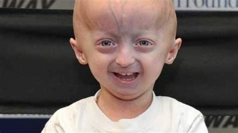 ¿qué Es La Progeria La Enfermedad Rara Que Produce El Envejecimiento
