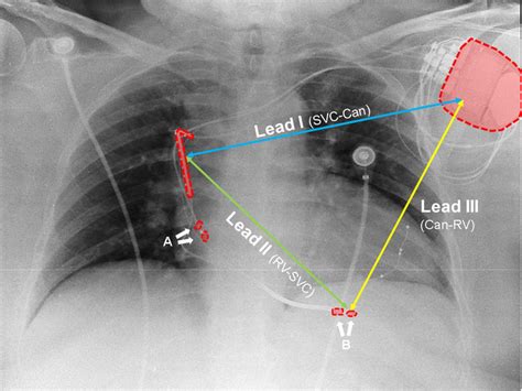Icd Vs Pacemaker Cxr Cardiac Implantable Electronic Devices Cied On