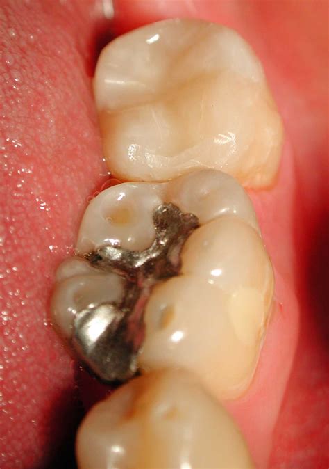 Composite Fillings | Deutsche Dental Clinic