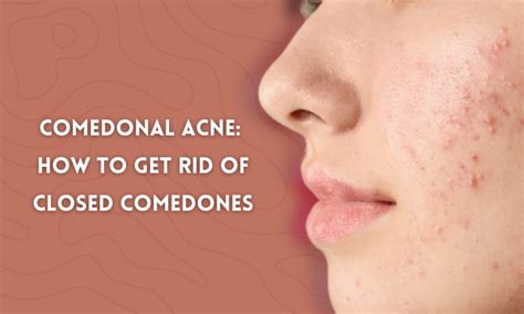 Comedonal Acne How To Get Rid Of Closed Comedones Skin Beauty