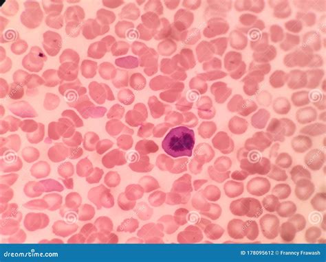 Dysplastic Erythroblast Blood Test Red Blood Cells Stock Photo
